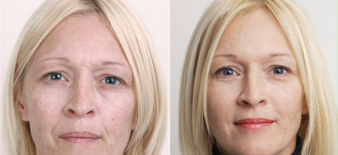 Botox - Botulinumtoxin A - vorher/nachher - Beispiel 3